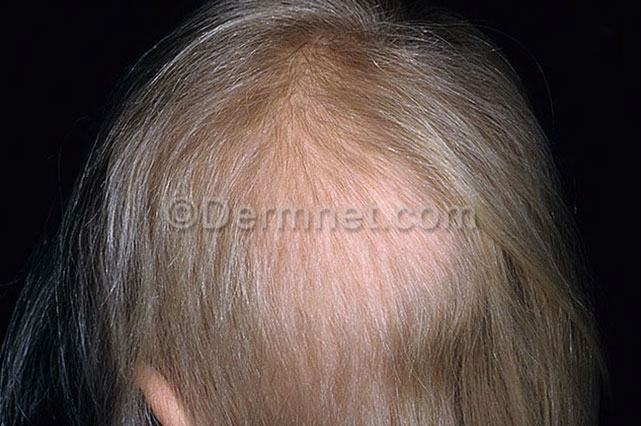 Alopecia Areata