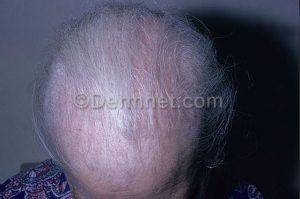 Alopecia Areata