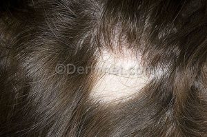 Alopecia Areata
