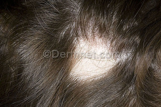 Alopecia Areata