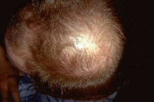 Female Pattern Hair Loss