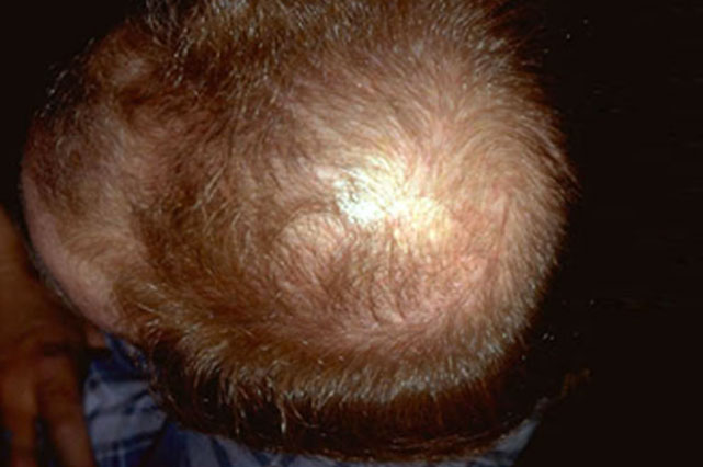 Female Pattern Hair Loss