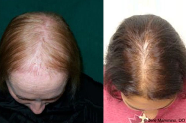 Female Pattern Hair Loss Hairdressers wantiing to specialise in Hair lOss