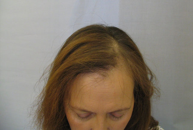 hair_loss_conditions_radiotherapy Radiotherapy and Hair Loss