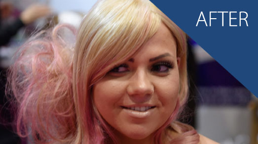 emma-after Emma's Alopecia Journey